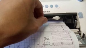 Фетальный монитор, кардиотокограф, монитор КТГ