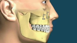 5  Остеотомия верхней челюсти