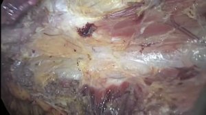 Боковая грыжа