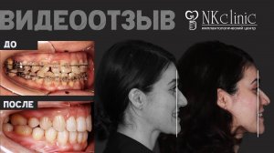 Исправили мезиальный прикус: отзыв пациентки об операции