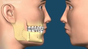 8  Остеотомия нижней челюсти