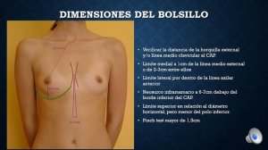 Implantes Mamarios Tecnica Subfascial Dr. Jose Carlos Zapata