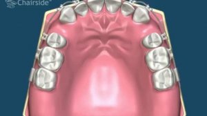 7 Удаление премоляров при дефиците места для клыков