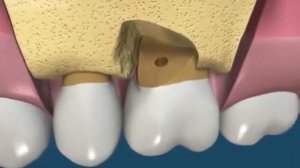 1 Ампутация корня верхнего моляра