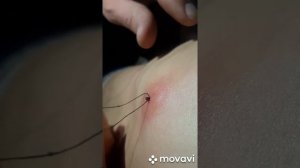Как правильно вытаскивать клеща!!