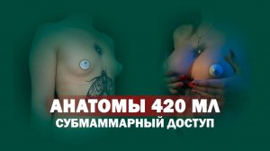 Увеличение груди анатомическими имплантами Ментор объемом 420 мл