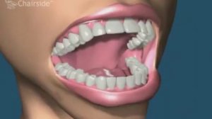 1 4 Полные съемные протезы