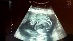 УЗИ на 24 неделе беременности