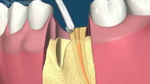 2  Гемисекция нижнего моляра
