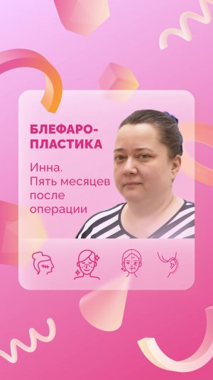 Инна. Верхняя блефаропластика. 5 месяцев после операции