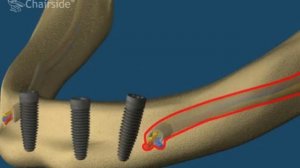 2 Все на 4 нижняя челюсть на мультиюнитах
