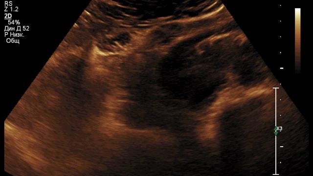 УЗИ Почек_Подковообразная почка