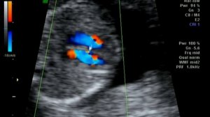 УЗИ нашей дочки. 16 недель. Daughter, 16 weeks pregnant ultrasound