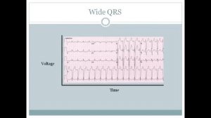 Arrhythmia Concepts,Tachy with Dr  Espinosa