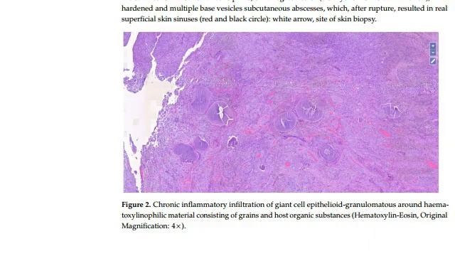 Skin Mycetoma - Science News and Research News