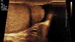 УЗИ_Полиорхизм