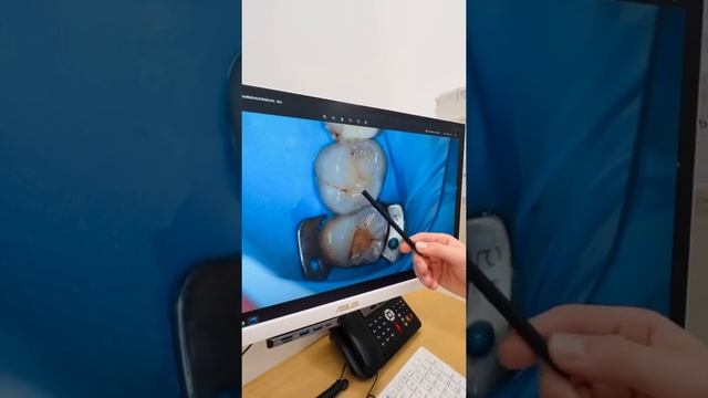 Реставрация жевательных зубов. Клинический случай