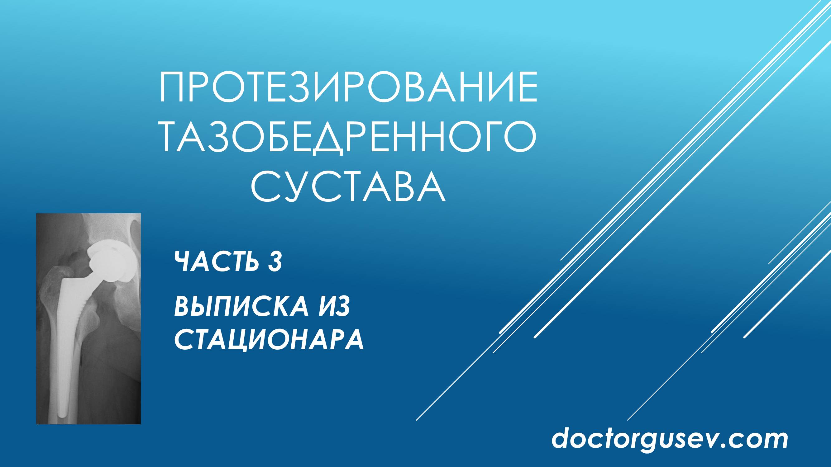 Как встать с кровати после операции эндопротезирования тазобедренного сустава