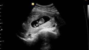 Посмотрите видеозапись УЗИ ребенка на сроке 7-10 недель.