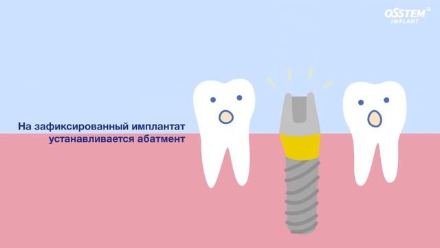 Имплантация процедура лечения