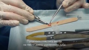 Установка 5-ти имплантатов в один визит. Антистресс-имплантация