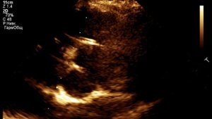 ЭХОКГ_ Двустворчатый аортальный клапан