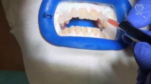 Отбеливание зубов ZOOM 4