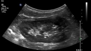 УЗИ ПОЧЕК_Гипертрофия колонки Бертина