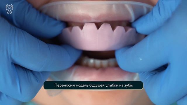Преображение улыбки. Процесс создания красивой улыбки в Belgravia Dental Studio