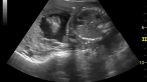 22 недели и 4 дня мальчик)узи