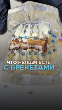 Что нельзя есть с брекетами 👇