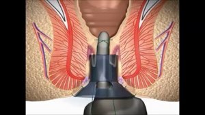 Stapled Haemorrhoidectomy using the PPH System - English
