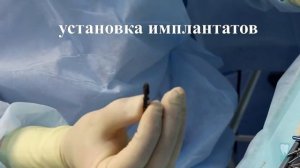 Имплантация по хирургическому шаблону с одномоментной нагрузкой. DIO navi.