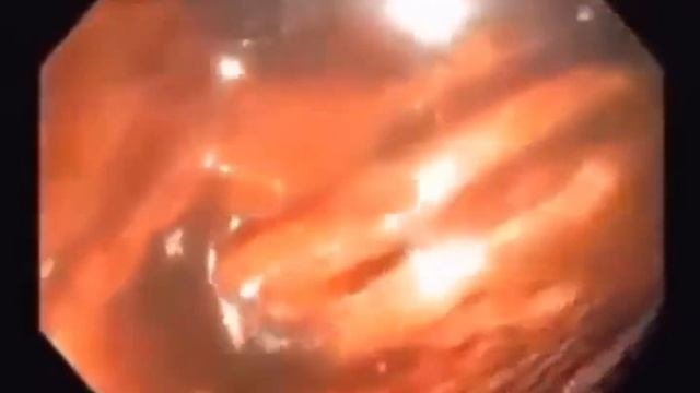 ЗДОРОВЬЕ И ЧИСТОТА КИШЕЧНИКА