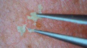 0235 keratin plug removal nose