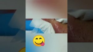 Давить жирные прыщи и угри. Best of Giant Blackeads on The Ear