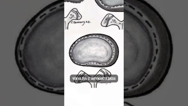 Что такое грыжа? Чем отличается от протрузии и экструзии? #мрт #кт