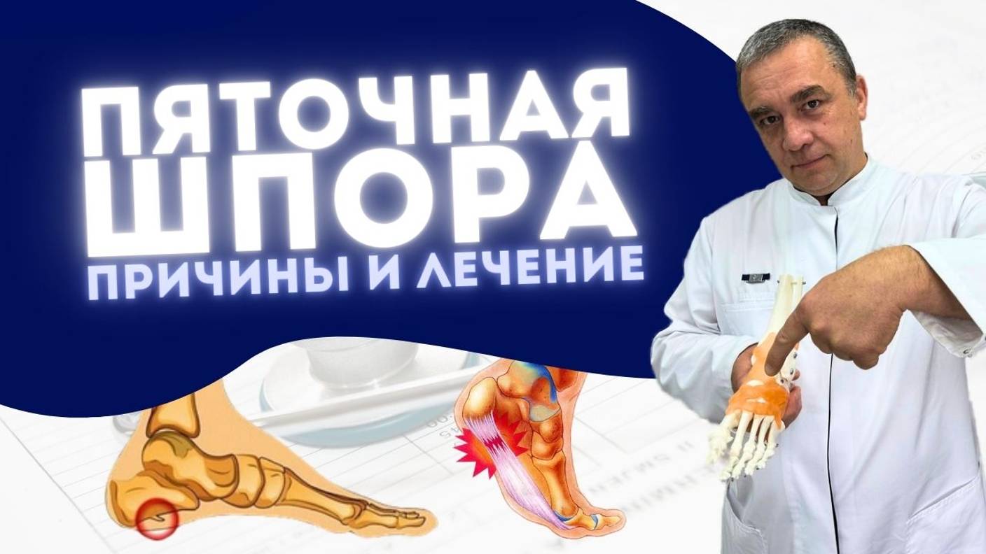 БОЛЬ В СТОПЕ. ПЯТОЧНАЯ ШПОРА | ПРИЧИНЫ И ЛЕЧЕНИЕ