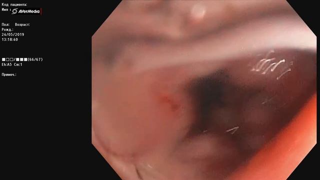 Язва прямой кишки после "низкой" реконструкции смотреть онлайн