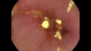 Болезнь Крона - диагностика методом Капсульной эндоскопии