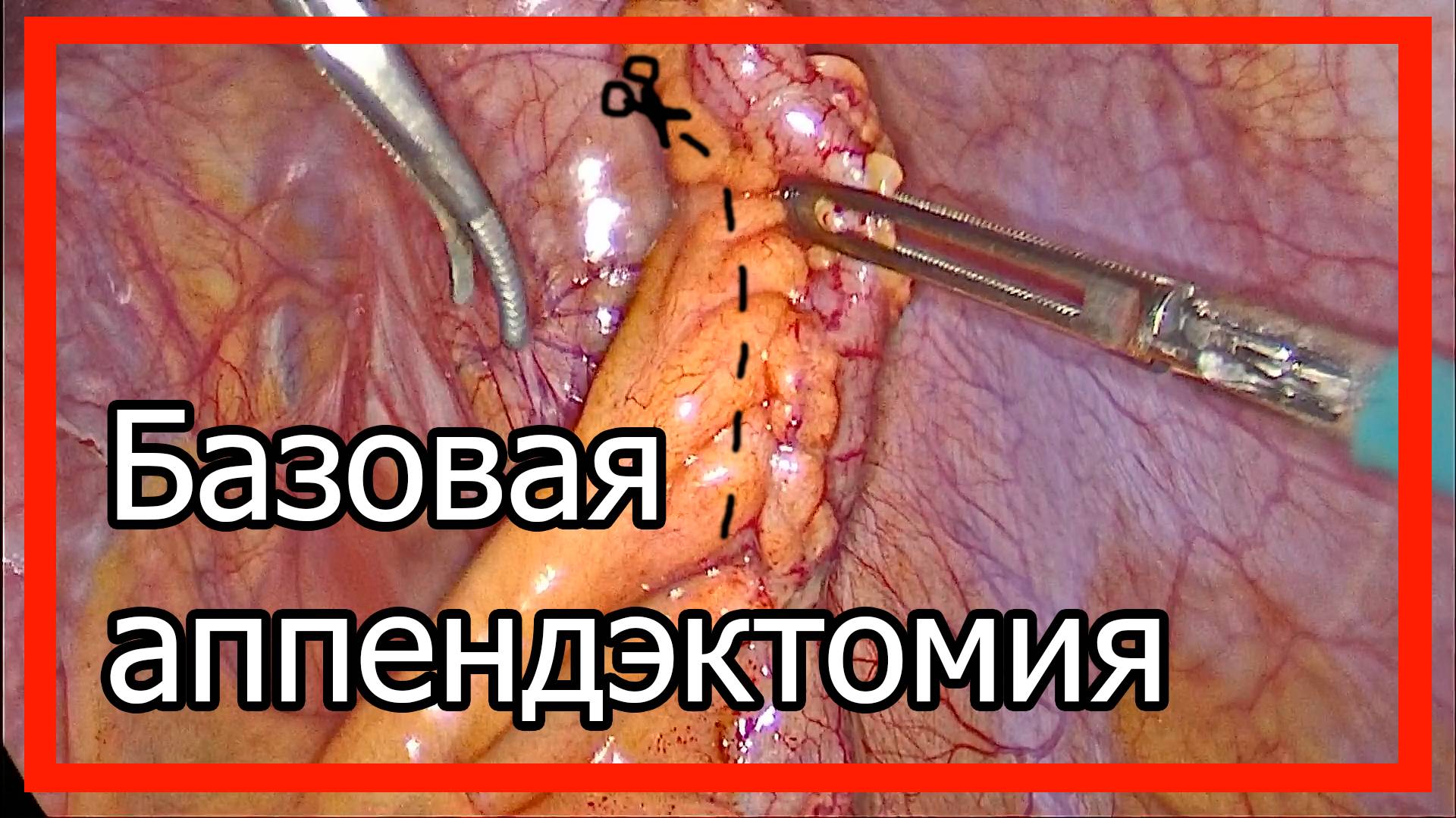 Базовая лапароскопическая аппендэктомия | Емельянов