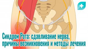 Синдром Рота: сдавливание нерва, причины возникновения и методы лечения