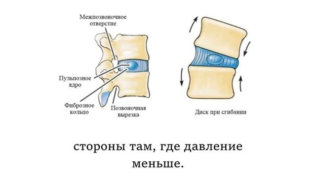 Грыжа межпозвонкового диска. (Когда причины - в искривлении и перекосах позвоночника)