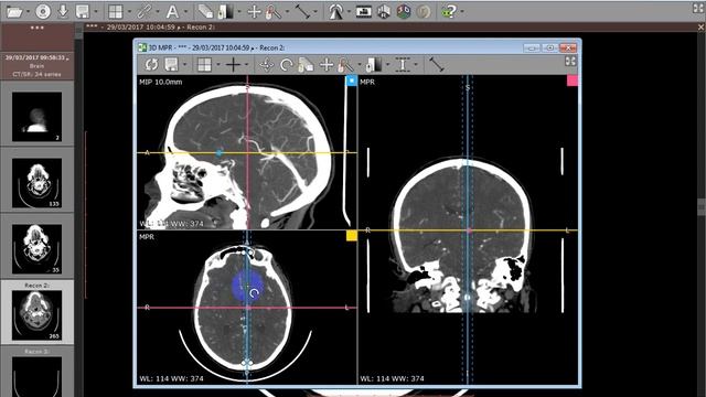 Radiant DICOM Magic functions MIP VR