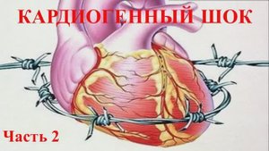 Кардиогенный шок. Часть вторая
