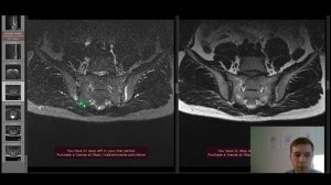 Воспаление в позвоночнике? Сакроилеит и болезнь Бехтерева в практике невролога. Что делать.