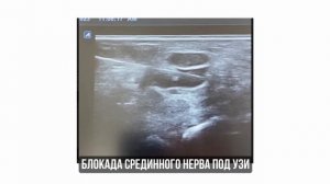 УЗИ  НЕРВОВ || Незаменимый метод диагностики при поражении  периферических нервов
