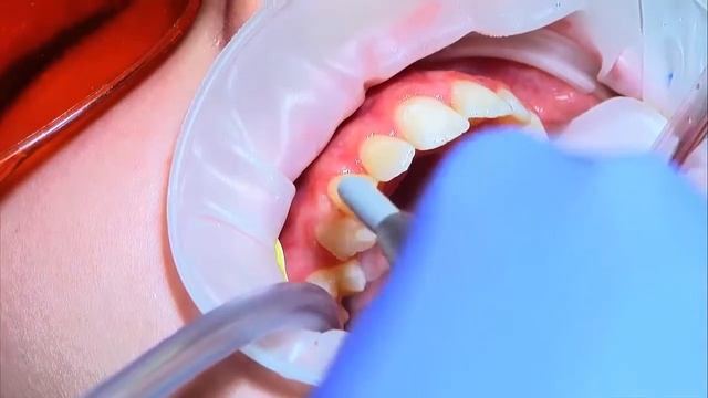 6 - eXceed IDB Chair-Side Bonding смотреть онлайн