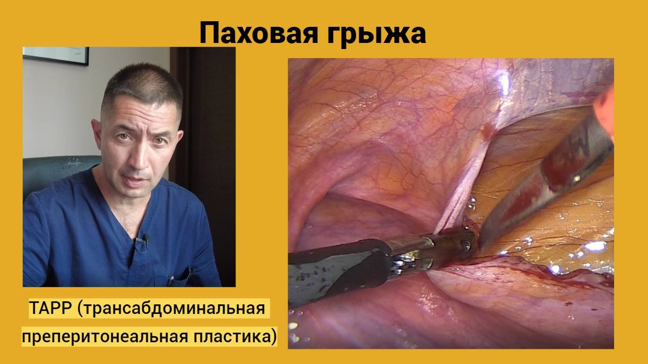 Паховая грыжа. TAPP (трансабдоминальная преперитонеальная пластика).
