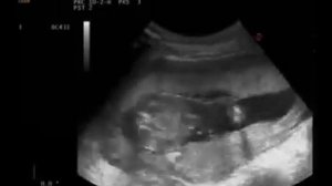 УЗИ 18 недель ultrasound  18 week